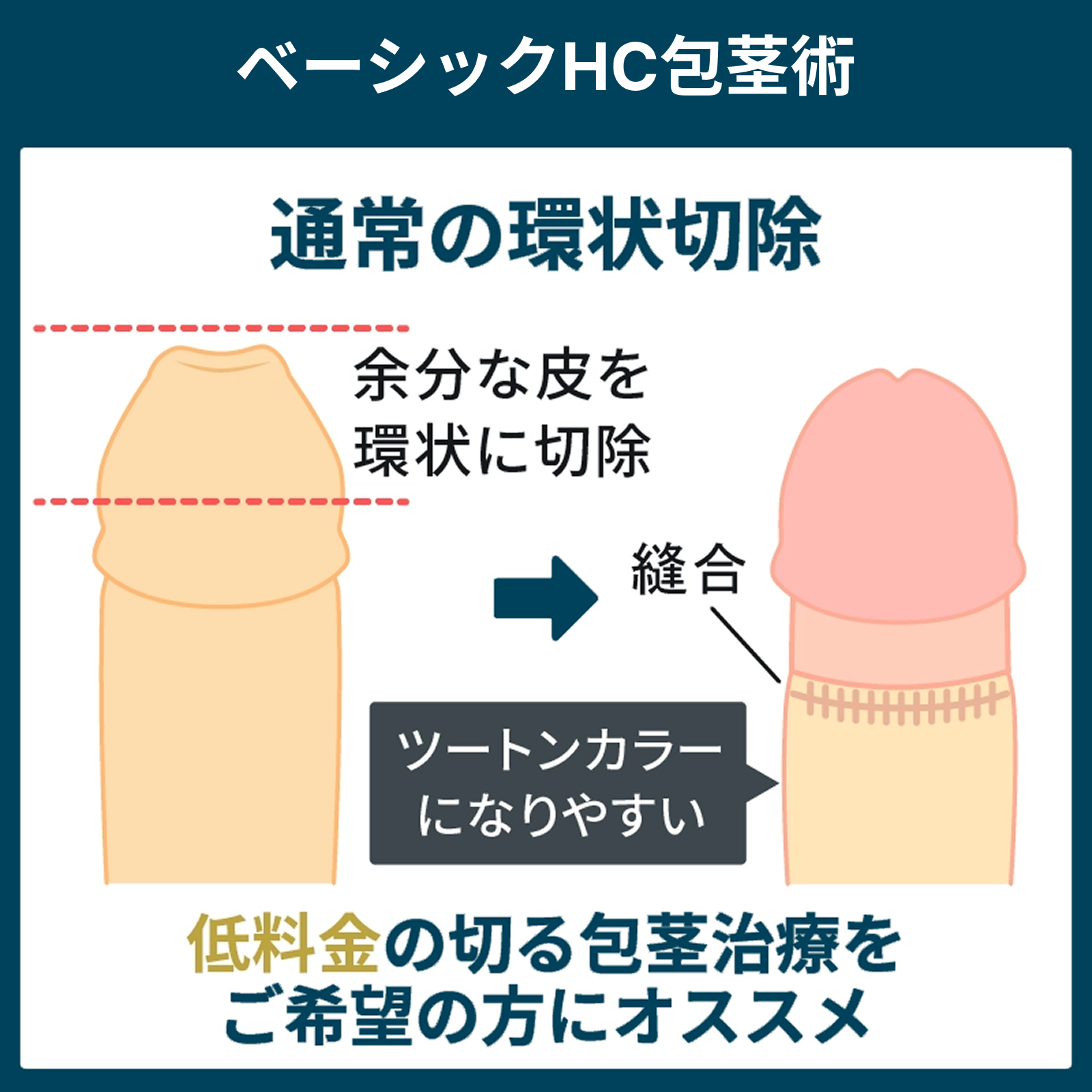 余分な包皮を環状に切除するベーシックHC包茎術の解説