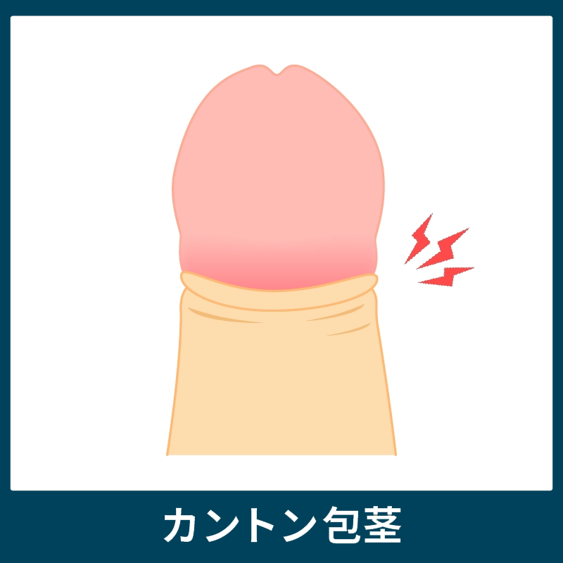 カントン包茎の陰茎(ペニス)
