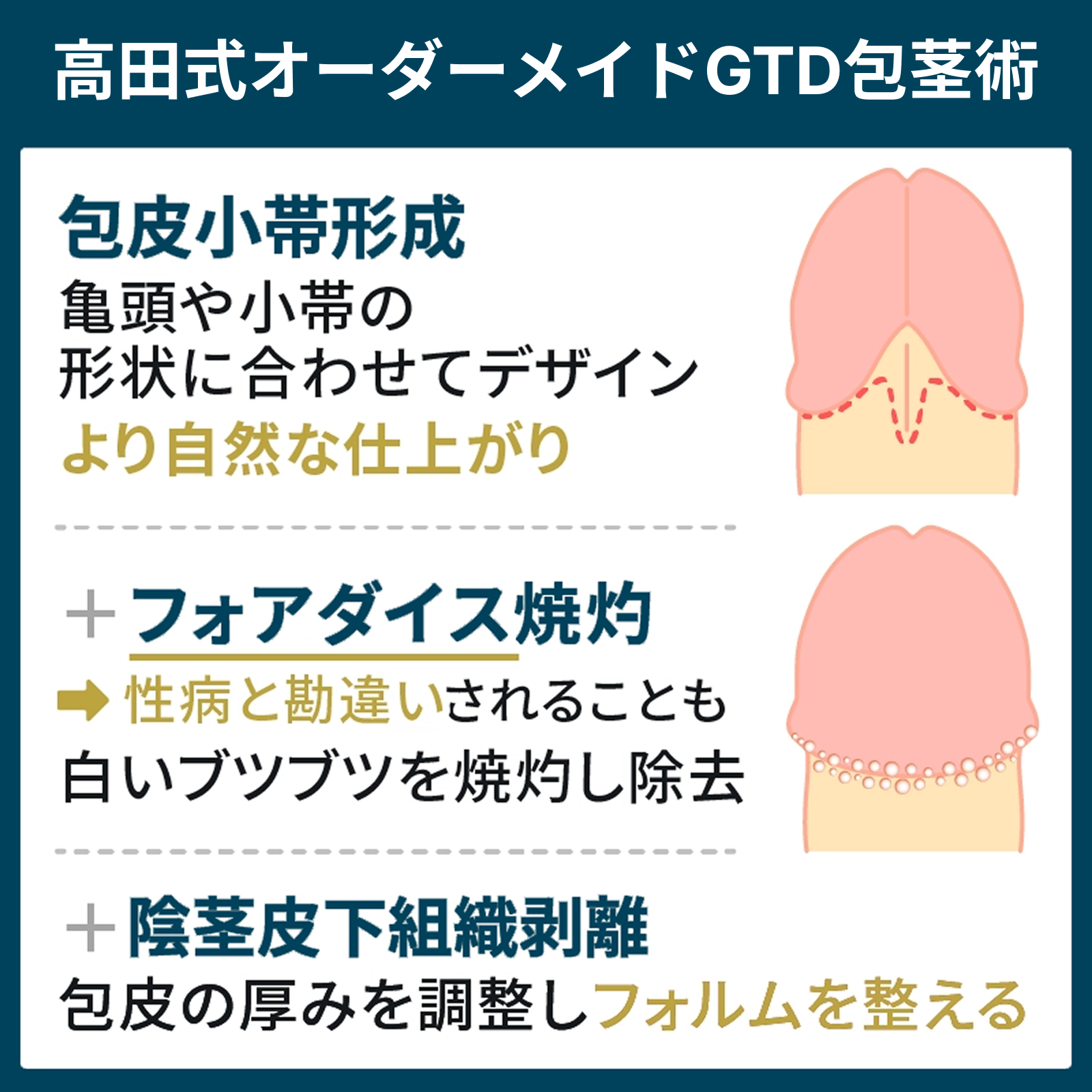 包茎の悩みを全て改善・解決、ズル剥けの維持なら高田式オーダーメイドGTD包茎術