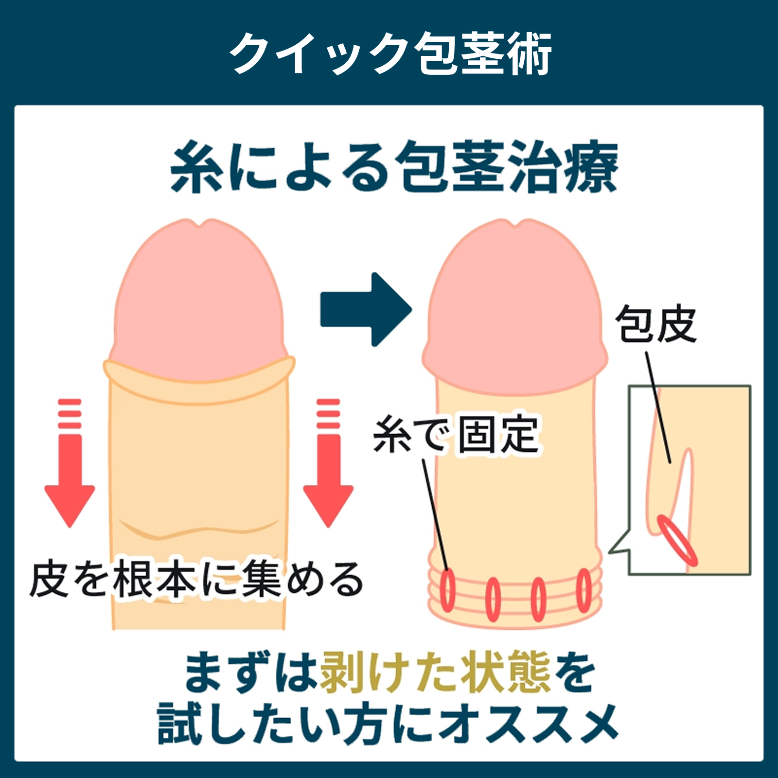 切らない包茎手術のクイック包茎術