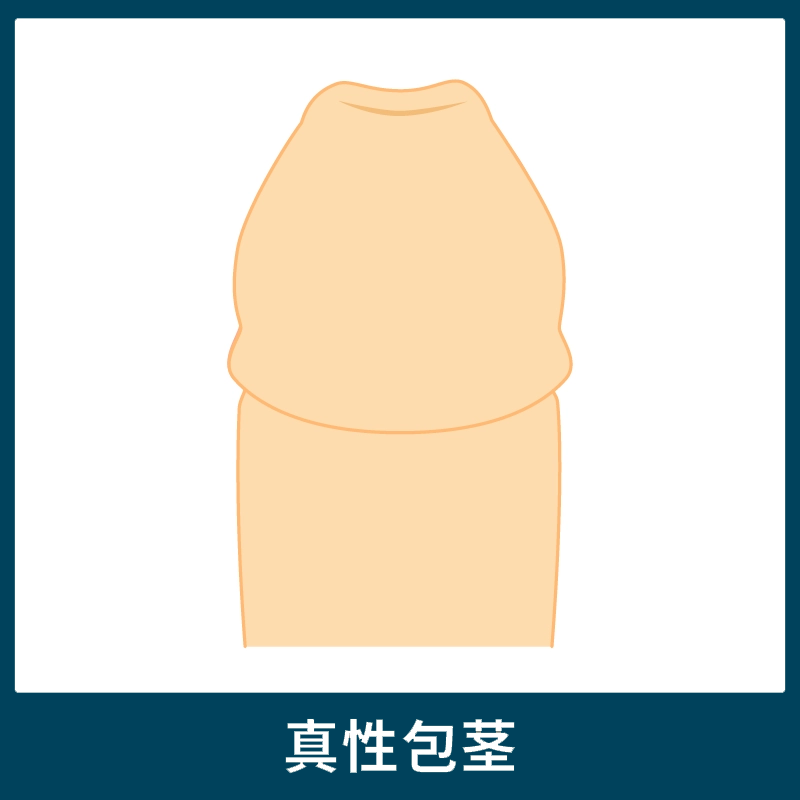 真性包茎の陰茎(ペニス)